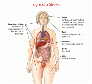 stroke-signs